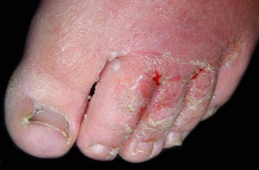 手足癣与灰指甲有什么不同